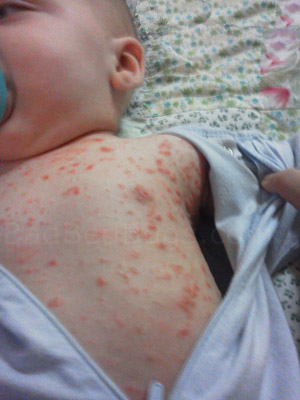 bed-bug-bites-on-an_infant