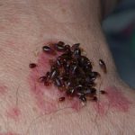 Can You Get AIDS From Bed Bugs?